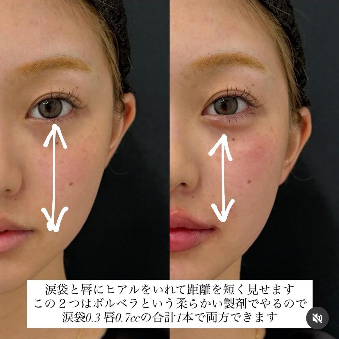 物理的に距離を短くする