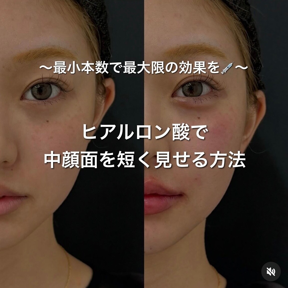 中顔面が長いと？