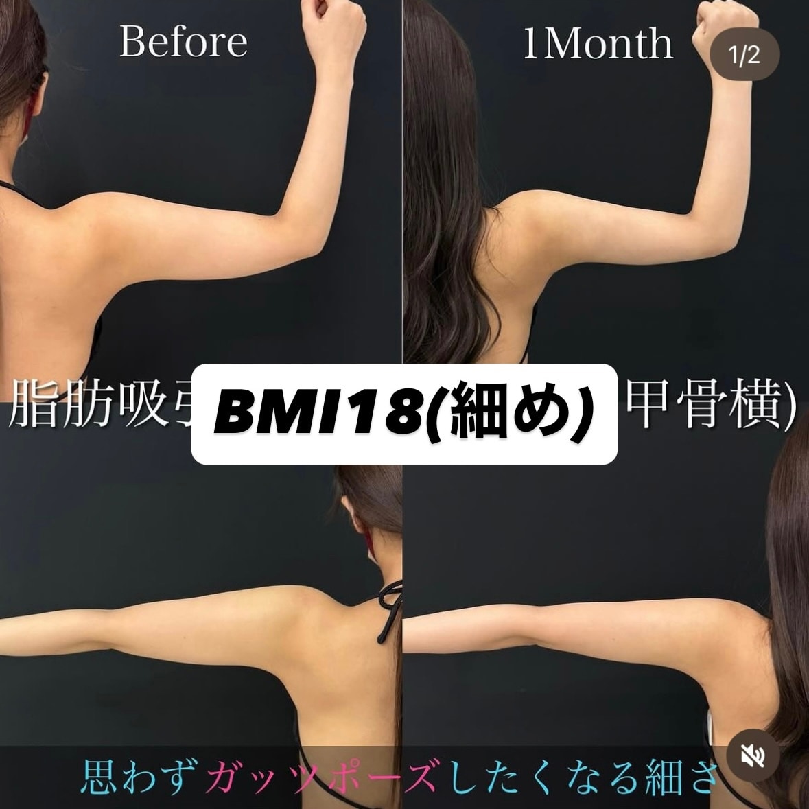 「最大限の根こそぎ脂肪吸引をしても綺麗にとにかく細く仕上がる」体型