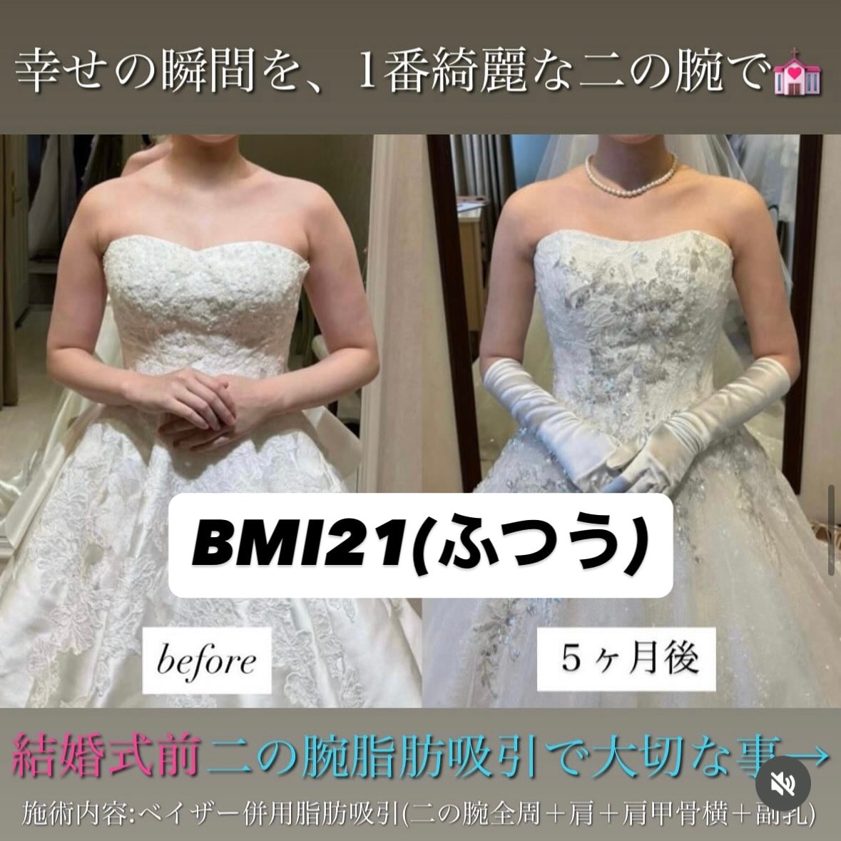 「二の腕の前面(全周)も脂肪吸引すべきかどうかが分かれてくる」体型