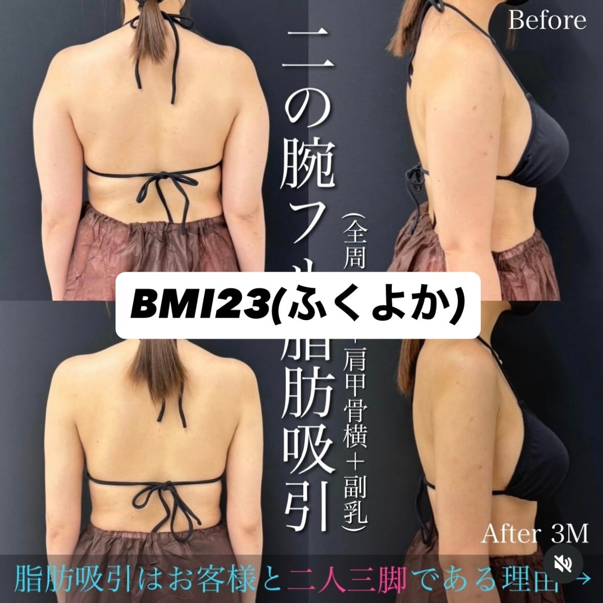「とにかく脂肪が沢山吸えて変化する」体型