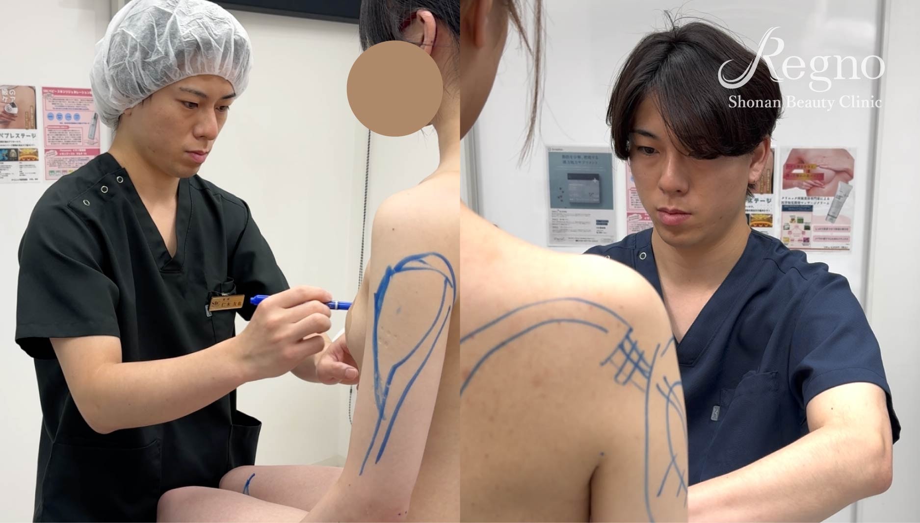 脂肪豊胸でどれくらい変化するの？