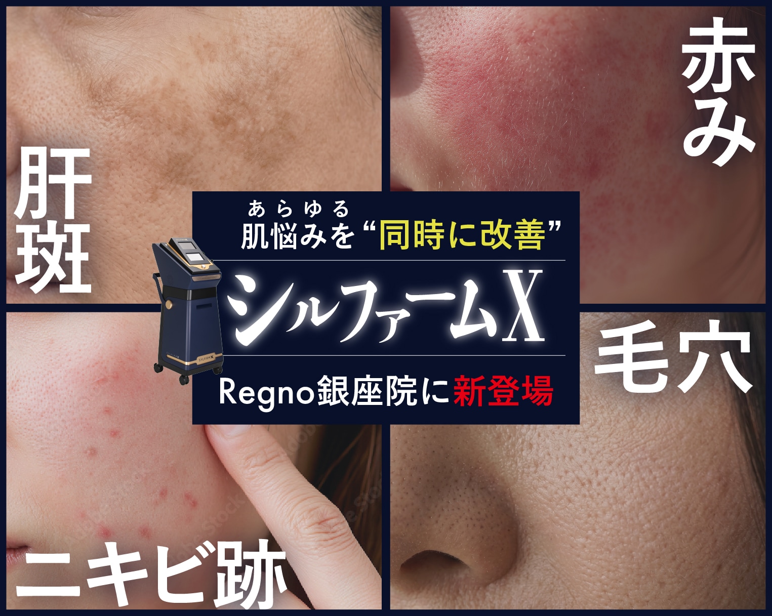 \肝斑・毛穴・ニキビ跡に/ 肌悩みを一気に改善する「シルファームX」を受けるならRegno銀座院★