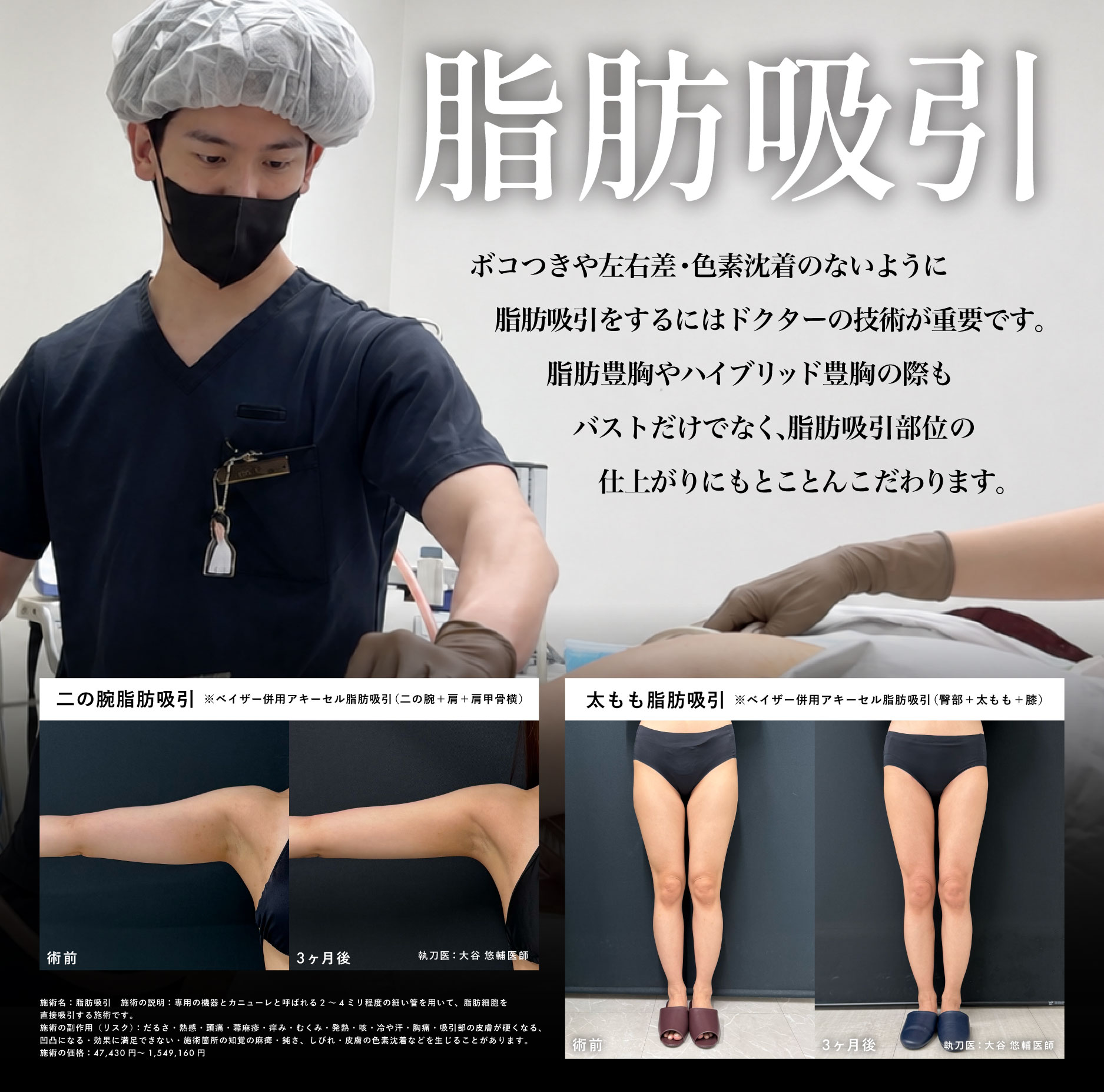 ボコつきなく、なめらかな仕上がりの脂肪吸引