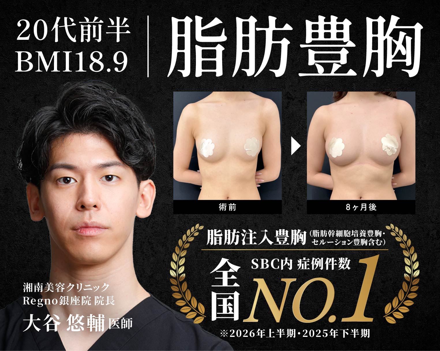 【SBC(湘南美容クリニック)で豊胸なら大谷先生】とにかくサイズを大きくしたい！20代前半の脂肪豊胸【東京・銀座の豊胸の名医・大谷悠輔医師】