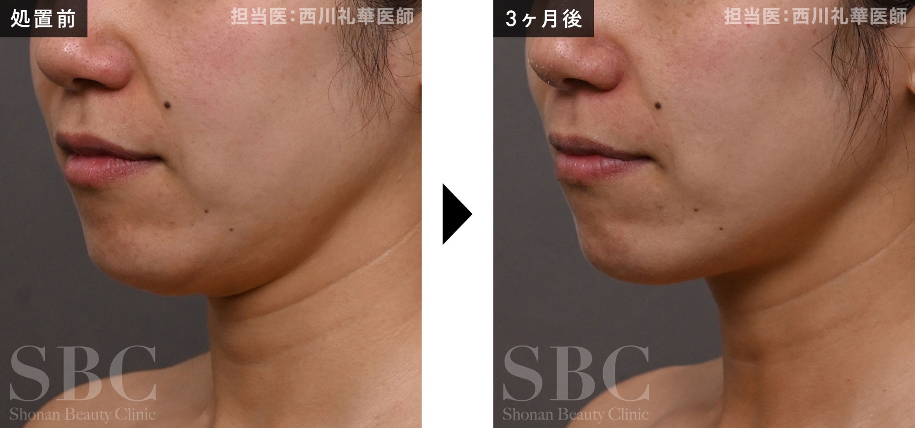 SBCハイフプログラム