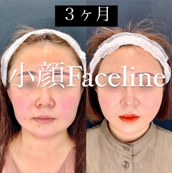 小顔 フェイスライン整形なら藤巻医師 インスタで人気の症例5選 札幌院