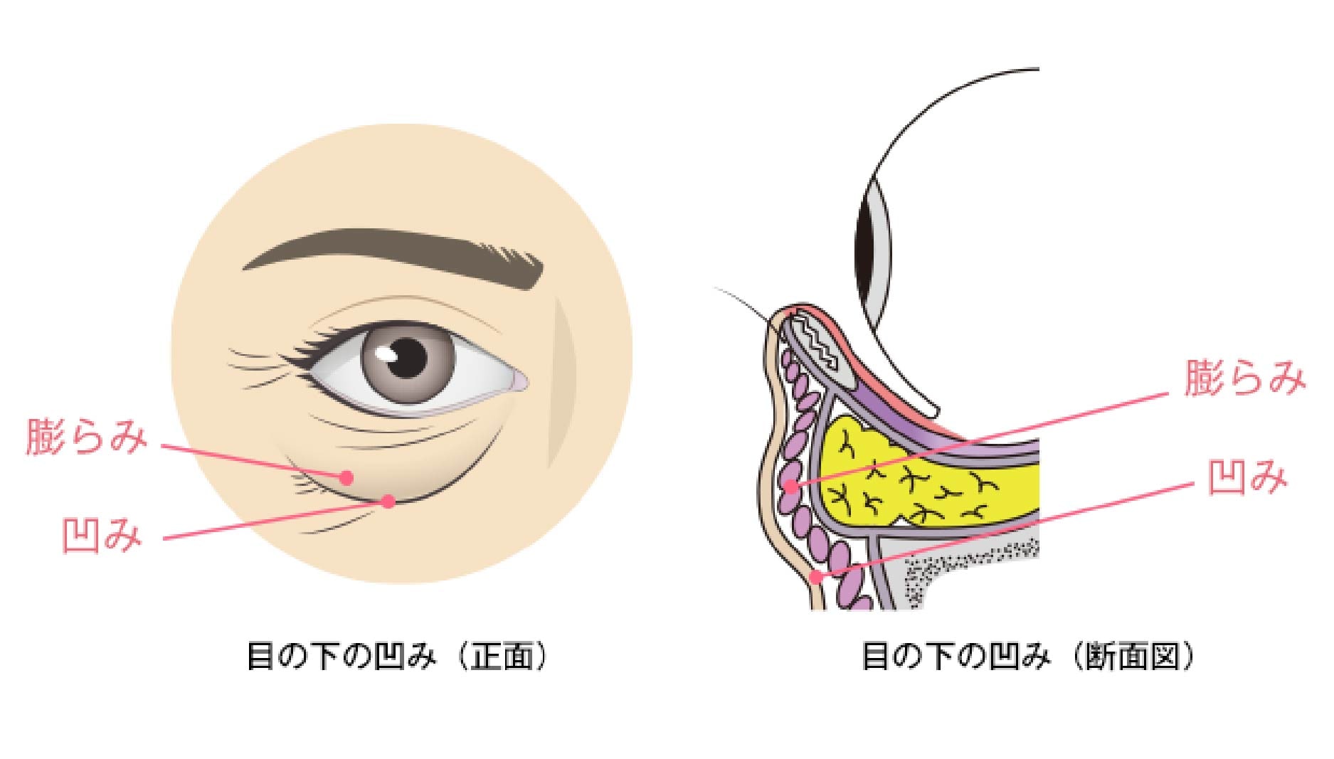 脂肪注入をする理由とは？