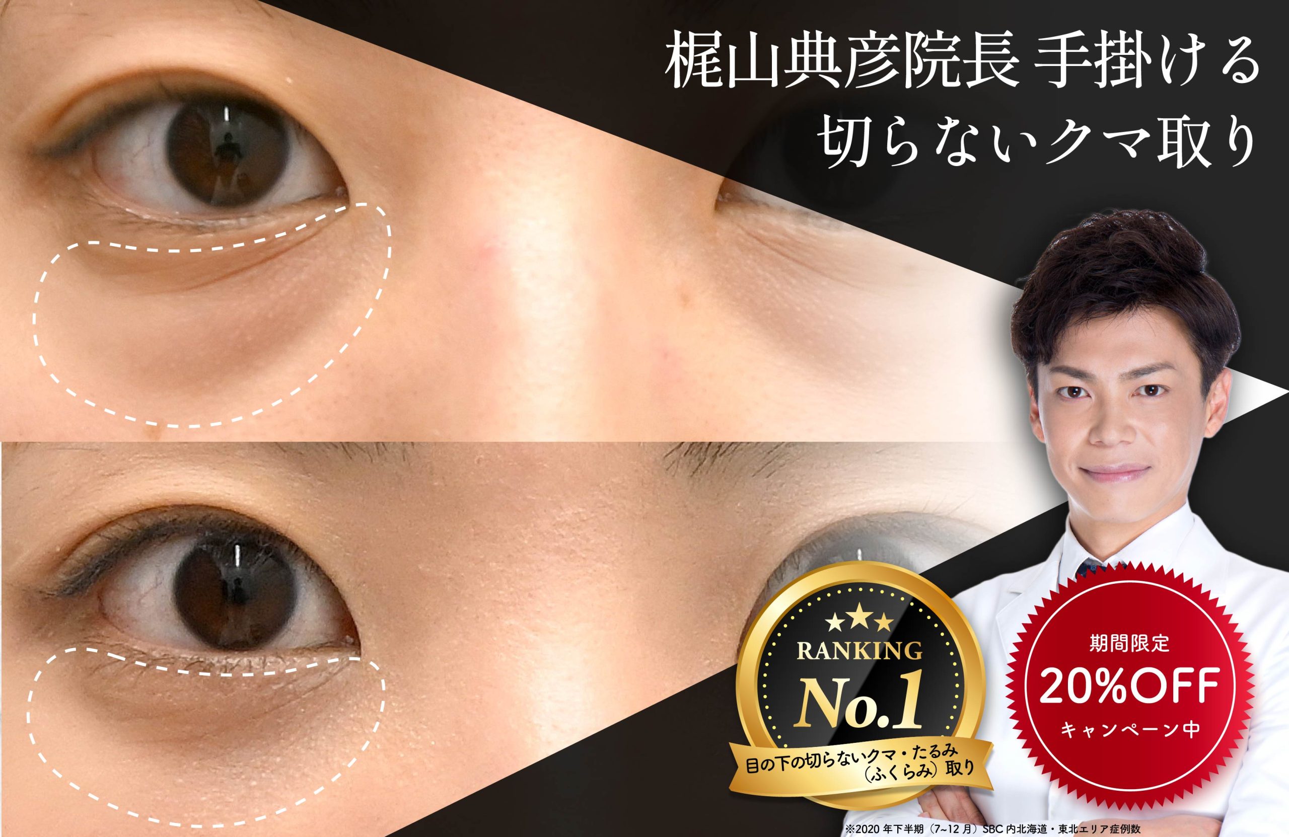 【クマ取り💝症例数No.1】期間限定20%OFF！🎉