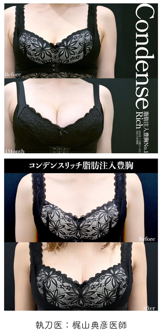 脂肪注入豊胸