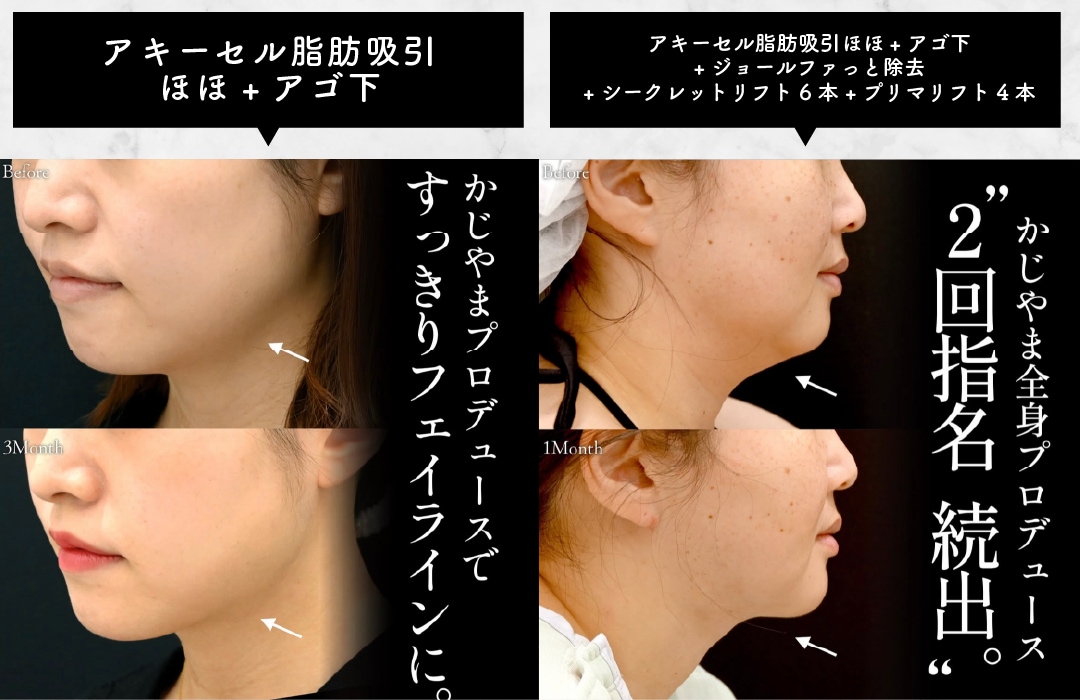 顔の脂肪吸引