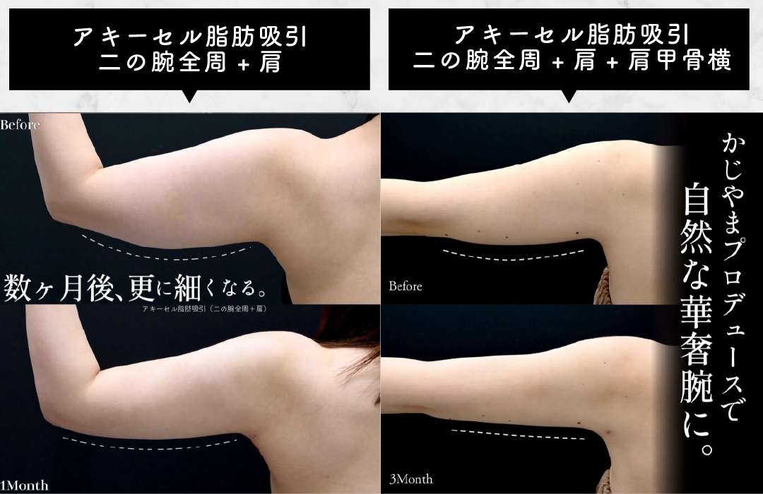 二の腕の脂肪吸引