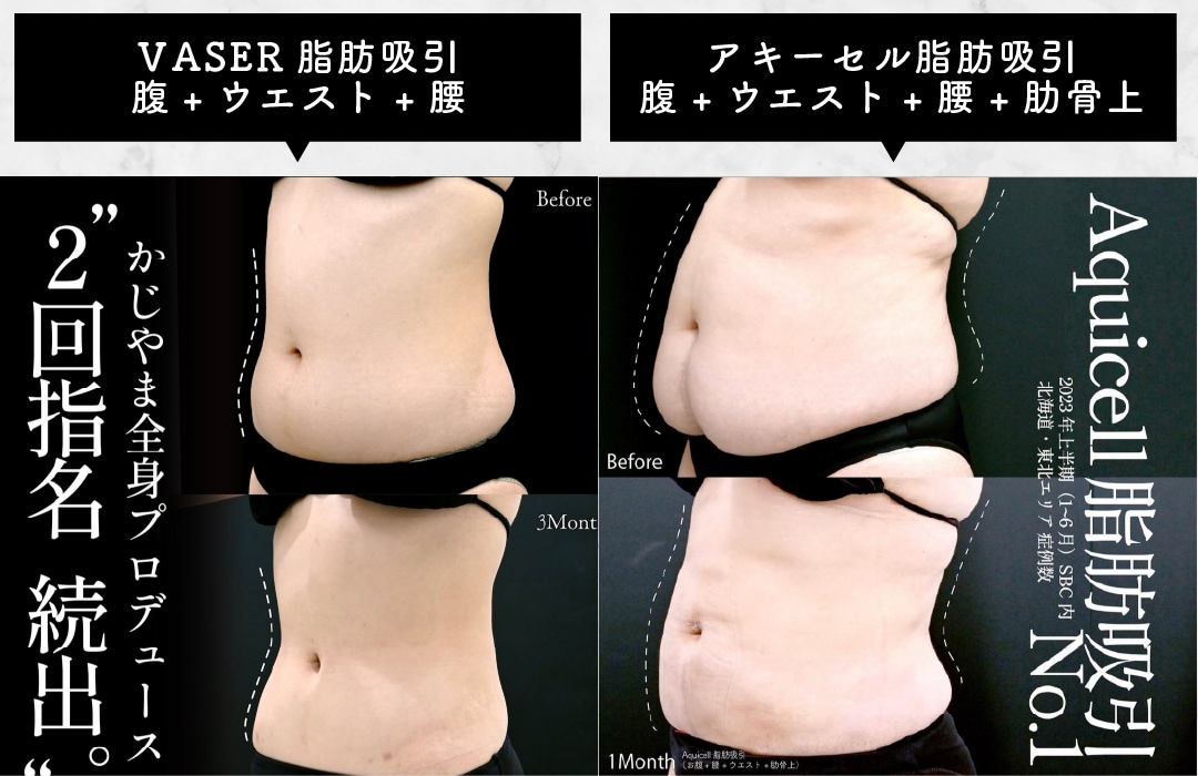 お腹の脂肪吸引
