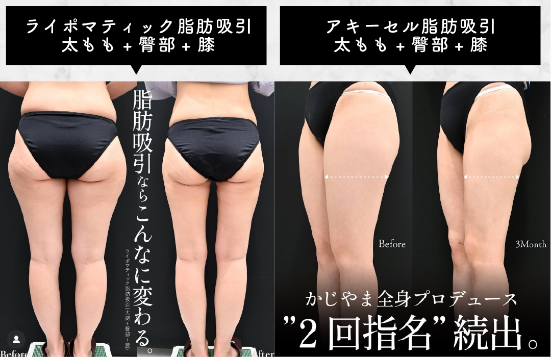 脚の脂肪吸引