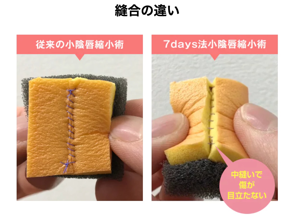 緻密な中縫いで術後から見た目すっきり