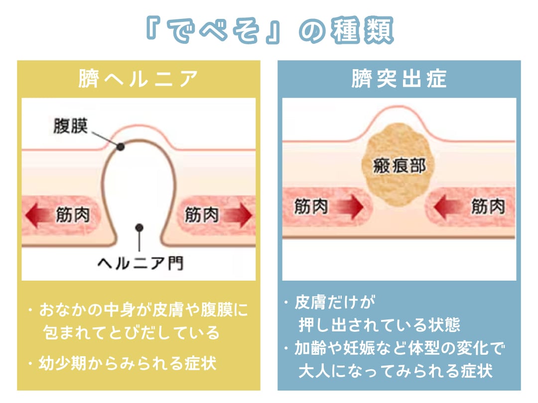 出臍の種類