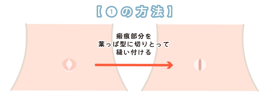 2種類の「出臍治療」で解決
