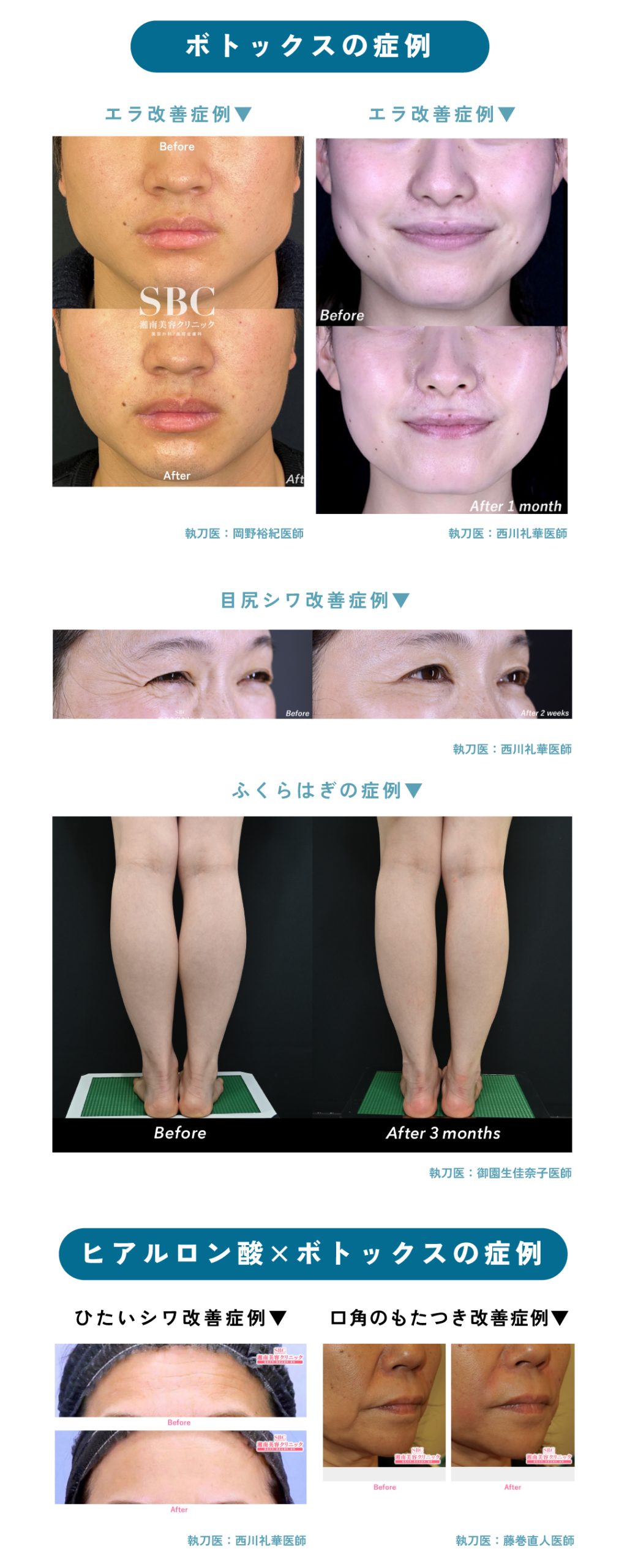 症例写真で見るボトックスの効果
