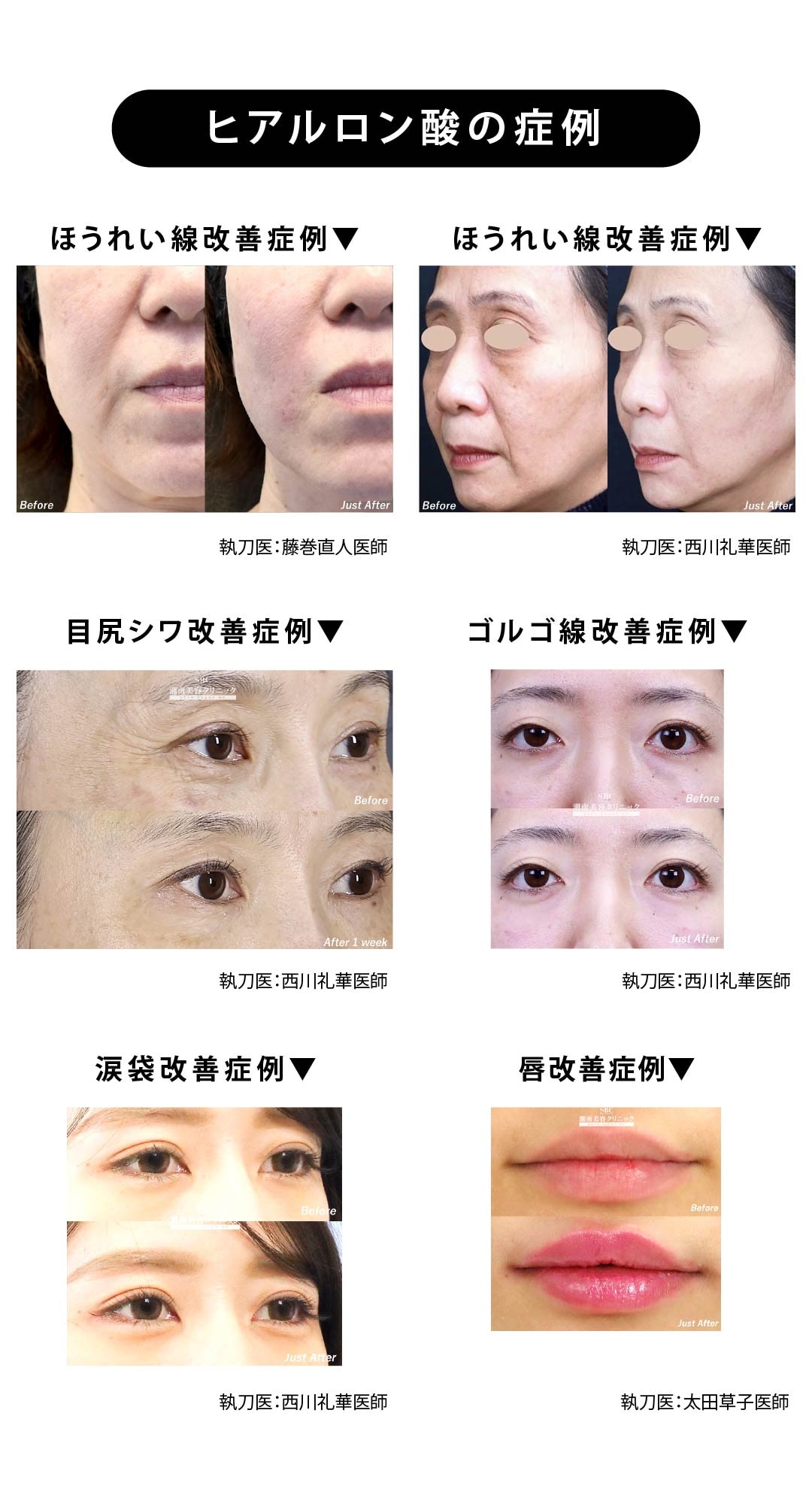 ヒアルロン酸を使った改善症例