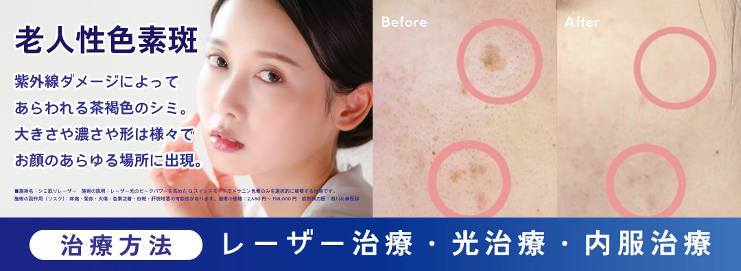 ①【老人性色素斑】