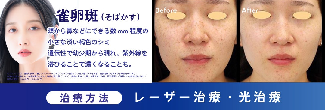 ②【雀卵斑＝そばかす】