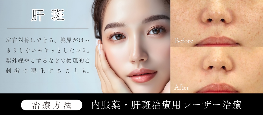 ③【肝斑】