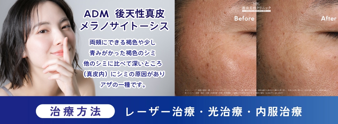 ④【ADM＝後天性真皮メラノサイトーシス 】