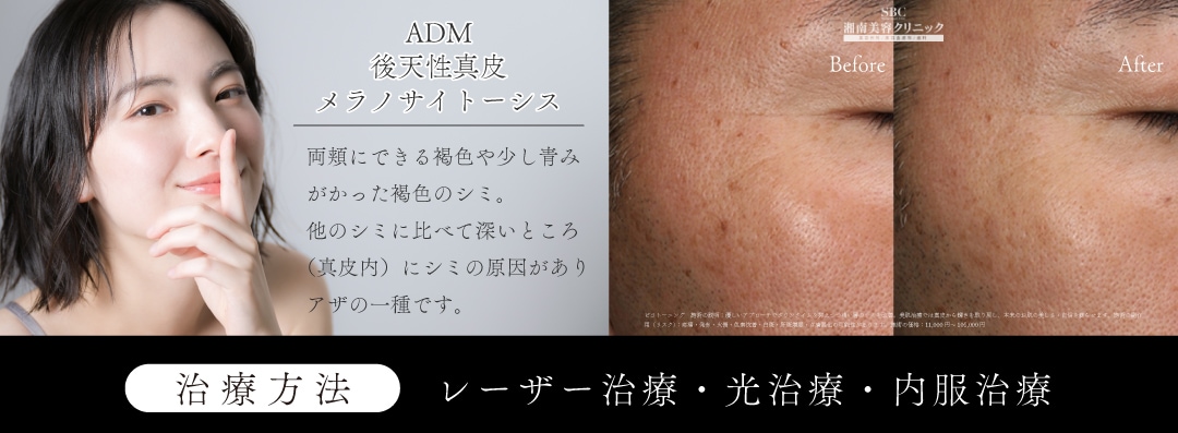 ④【ADM＝後天性真皮メラノサイトーシス 】