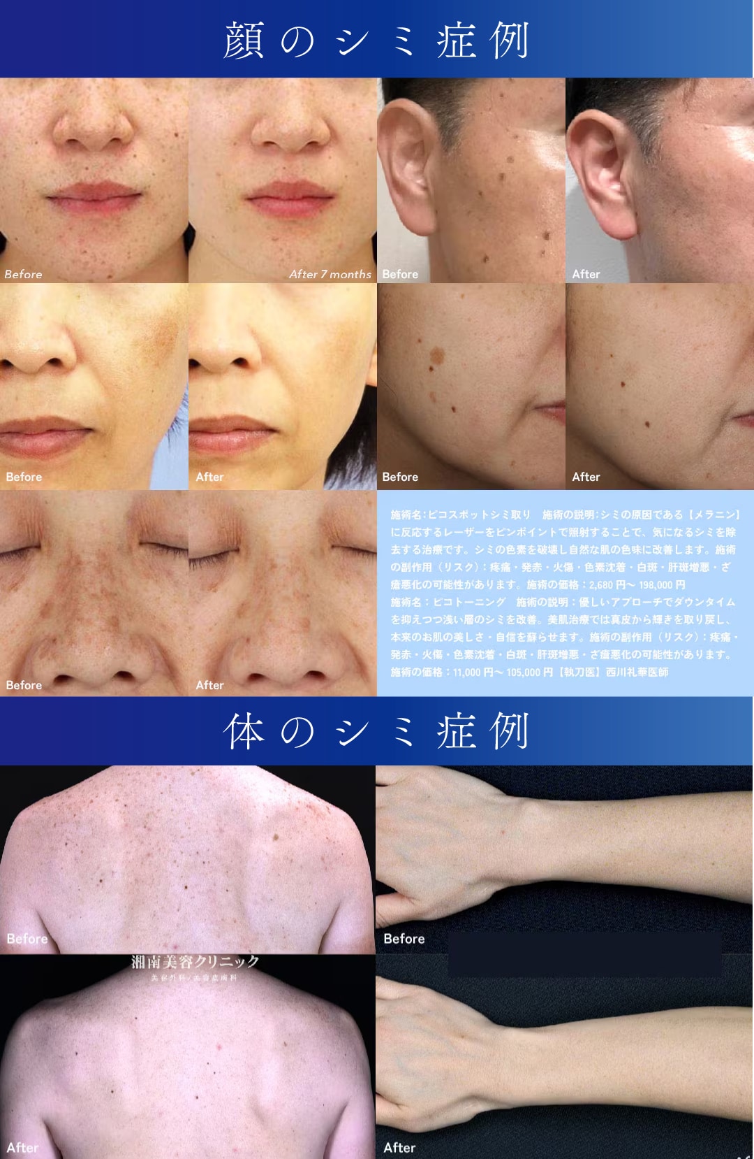 湘南美容クリニックのシミ取り症例写真