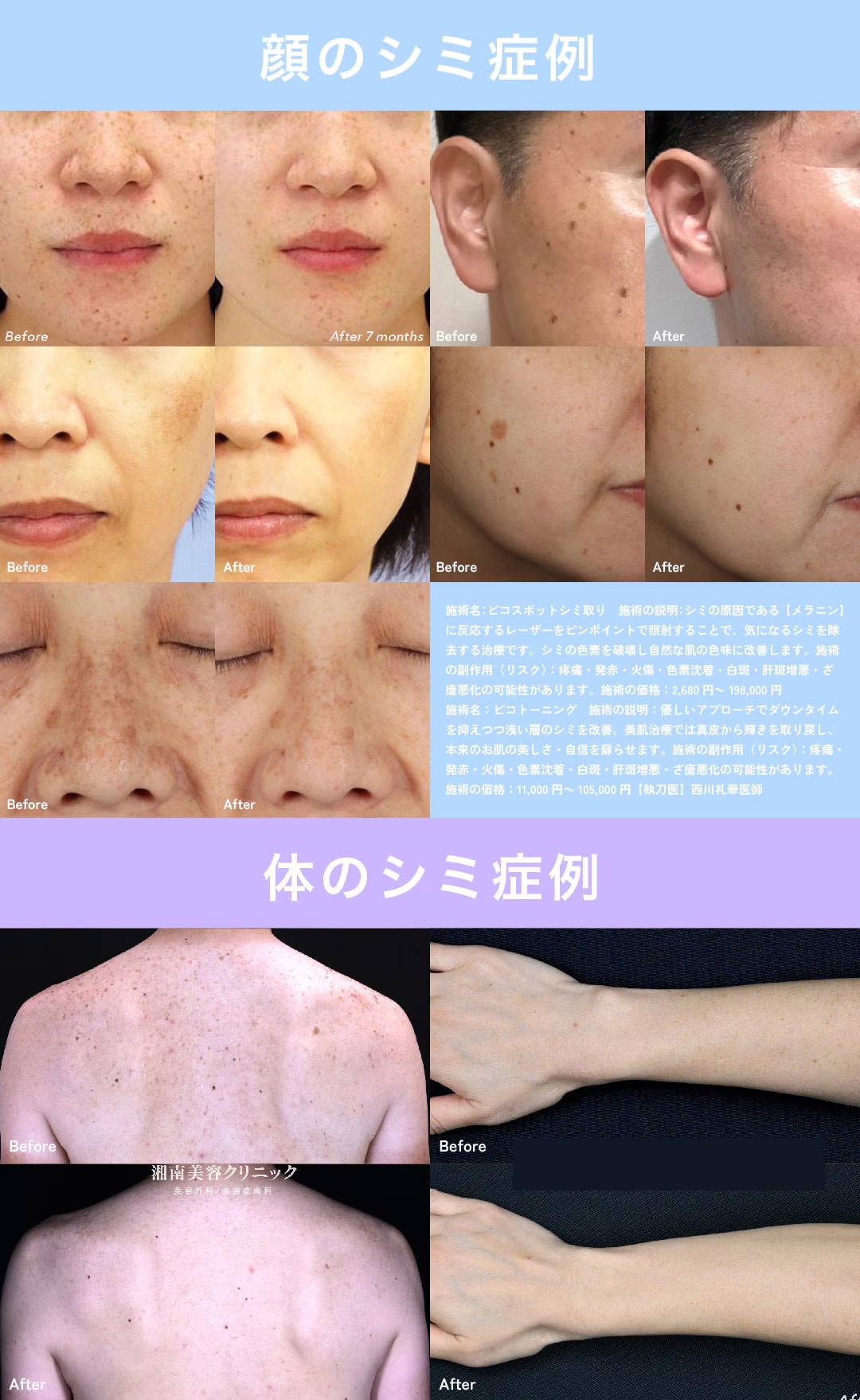 湘南美容クリニックのシミ取り症例写真