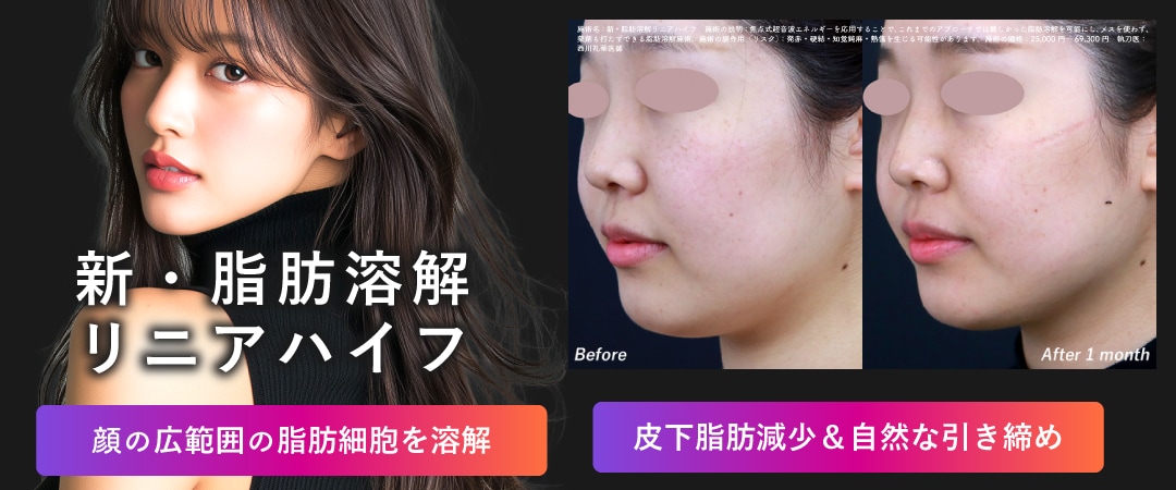 皮下脂肪撃退 ❺：新・脂肪溶解リニアハイフ