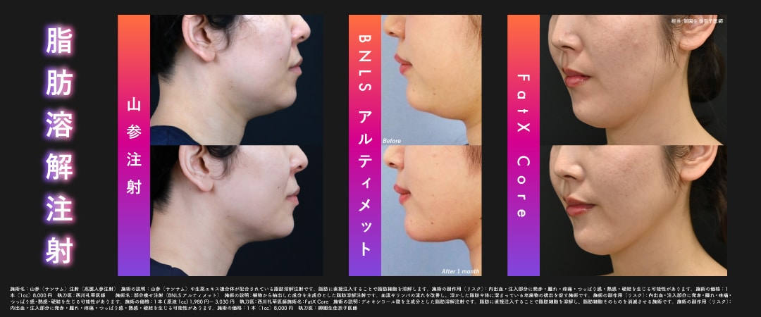 皮下脂肪撃退 ❹：脂肪溶解注射 