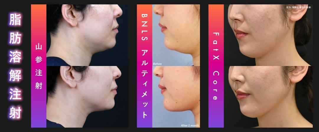 皮下脂肪撃退 ❹：脂肪溶解注射 