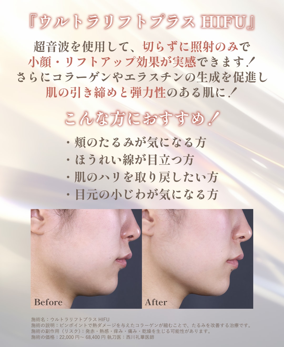 『ウルトラリフトプラスHIFU』ってどんな治療？