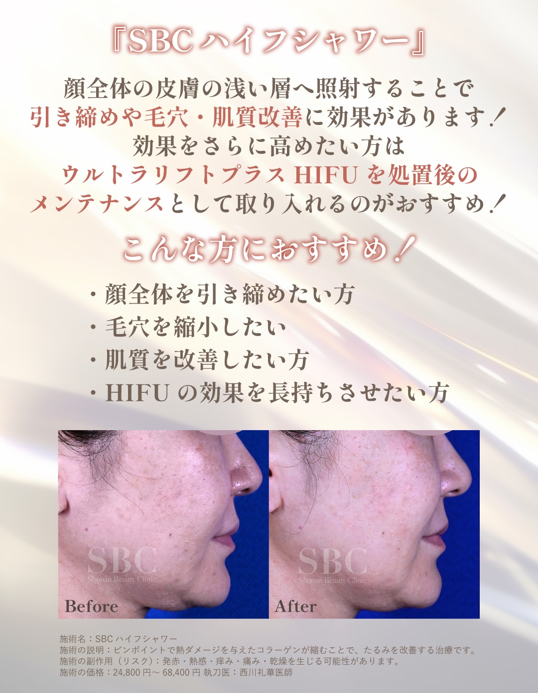 『SBCハイフシャワー』ってどんな治療？