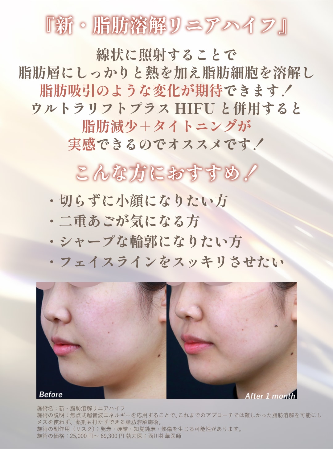 『新・脂肪溶解リニアハイフ』ってどんな治療？