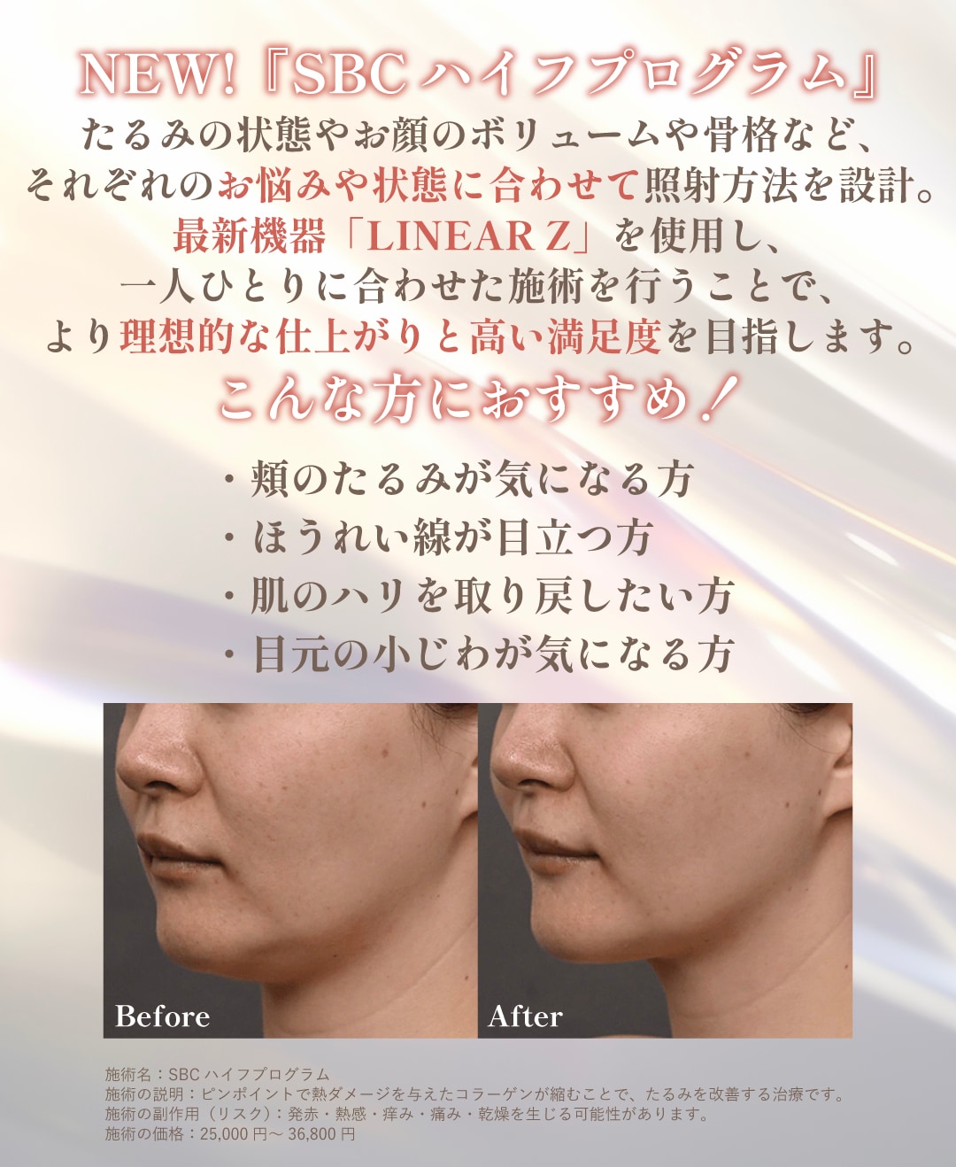 『SBCハイフプログラム』ってどんな治療？