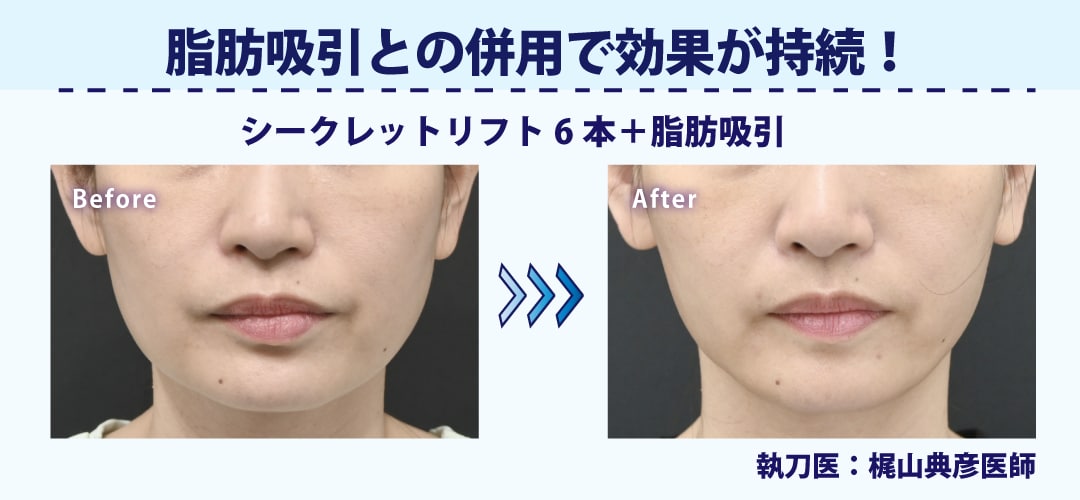 脂肪吸引との併用で引き上げ効果が持続！