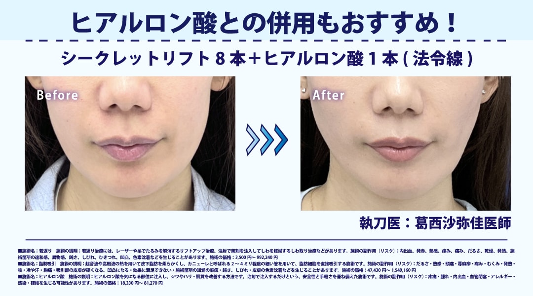 ヒアルロン酸との併用でより若々しい印象に！