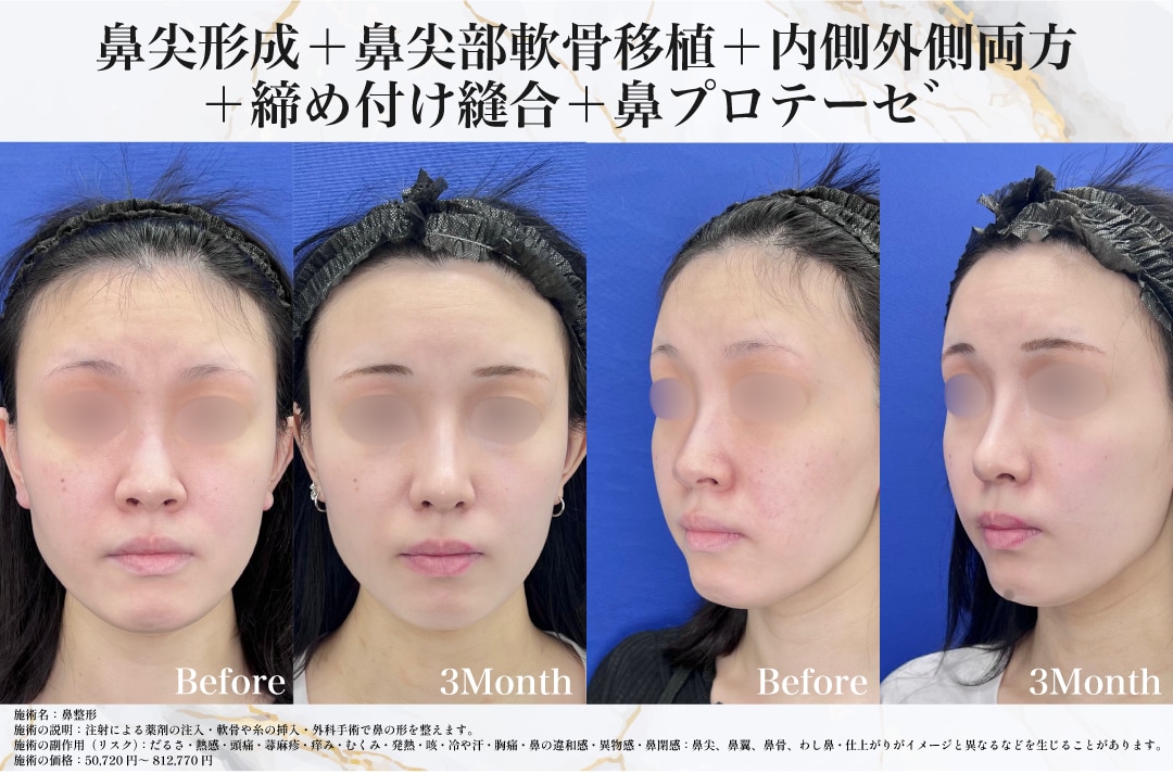 鼻整形
