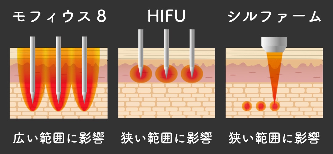 モフィウス8ってどんな治療？