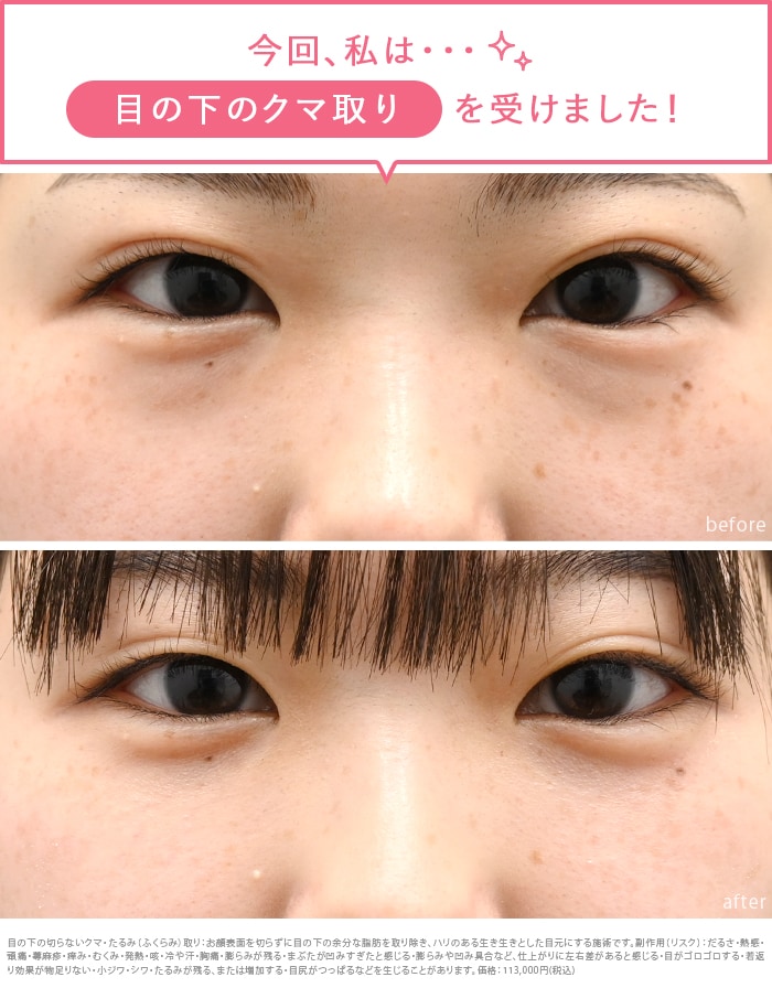 疲れて見える目元の印象を改善したい