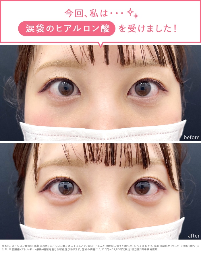 すっぴんでも盛れるぷっくりした涙袋が欲しい