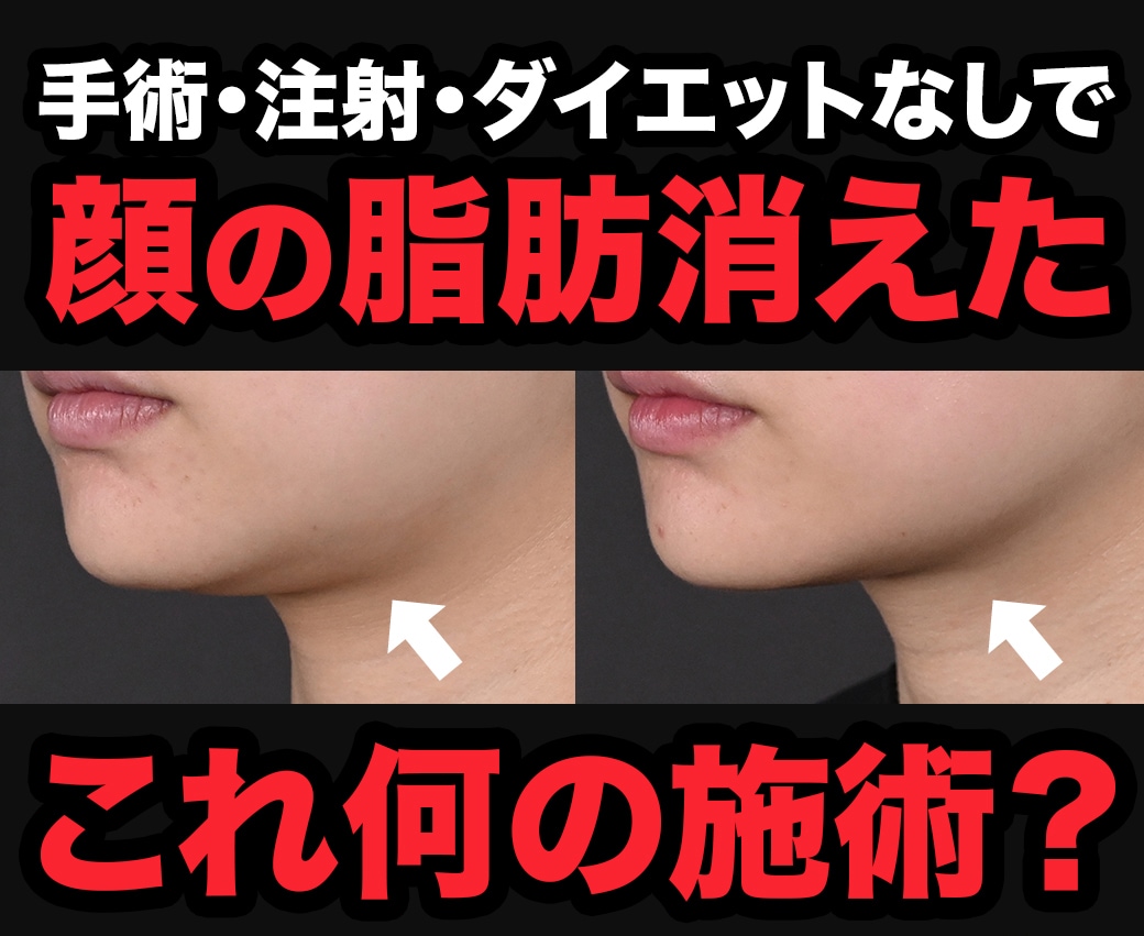 顔の脂肪が消える施術