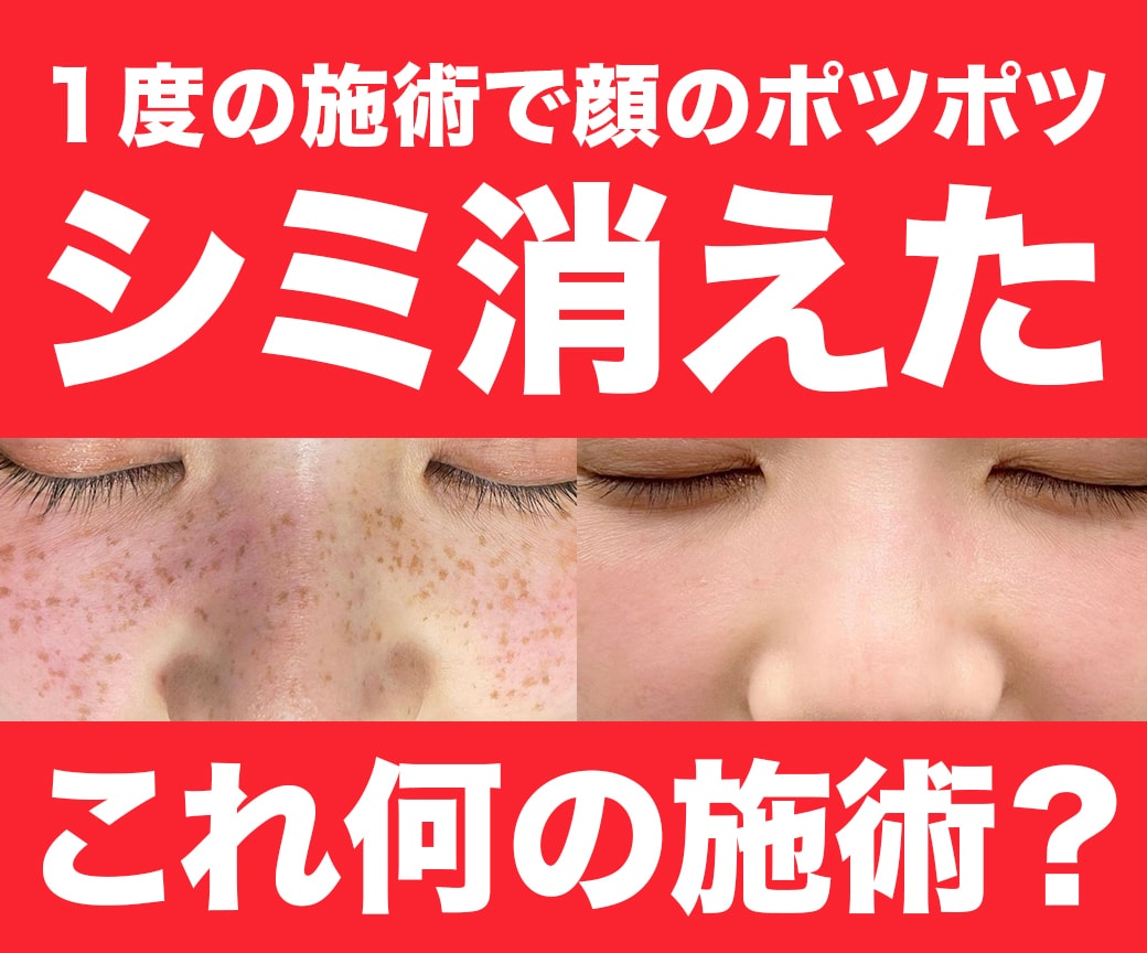 シミ取り放題症例