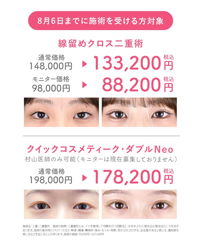 ピックアップキャンペーン_二重整形
