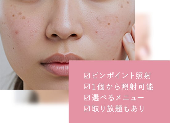 シミ取り