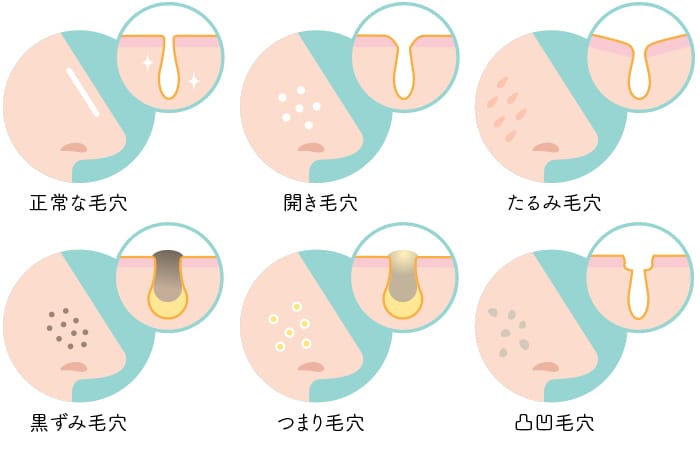 あなたの毛穴はどのタイプ？