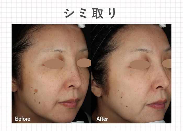 ❶シミ取り