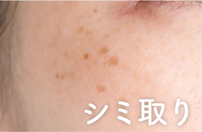【シミ取り】お顔・体のシミ取り放題ございます♡
